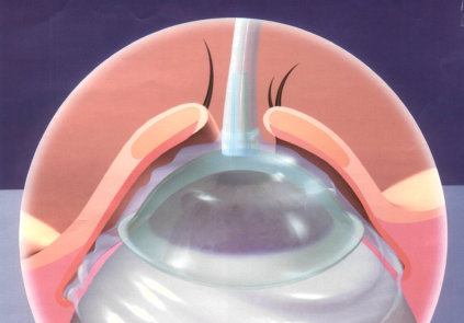 morganlens morgan lens eye irrigation øjenskyl øjenskylning